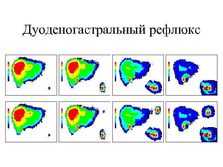 Дуоденогастральный рефлюкс 