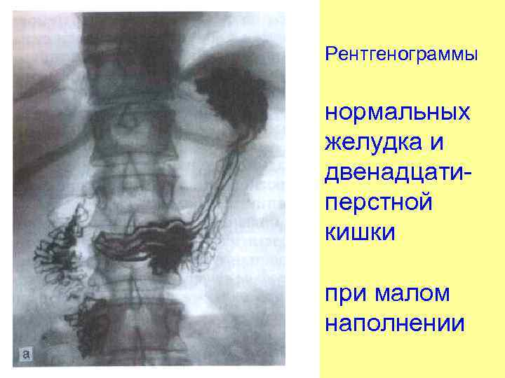 Рентгенограммы нормальных желудка и двенадцатиперстной кишки при малом наполнении 