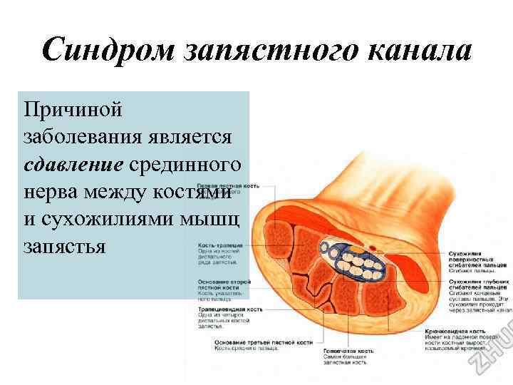 Синдром запястного канала Причиной заболевания является сдавление срединного нерва между костями и сухожилиями мышц