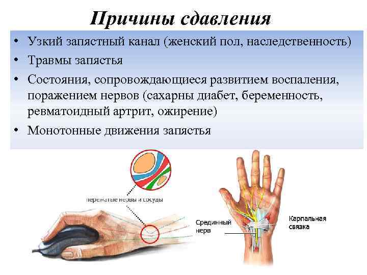 Причины сдавления • Узкий запястный канал (женский пол, наследственность) • Травмы запястья • Состояния,