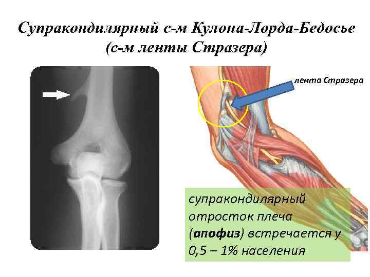 Супракондилярный с-м Кулона-Лорда-Бедосье (с-м ленты Стразера) лента Стразера супракондилярный отросток плеча (апофиз) встречается у