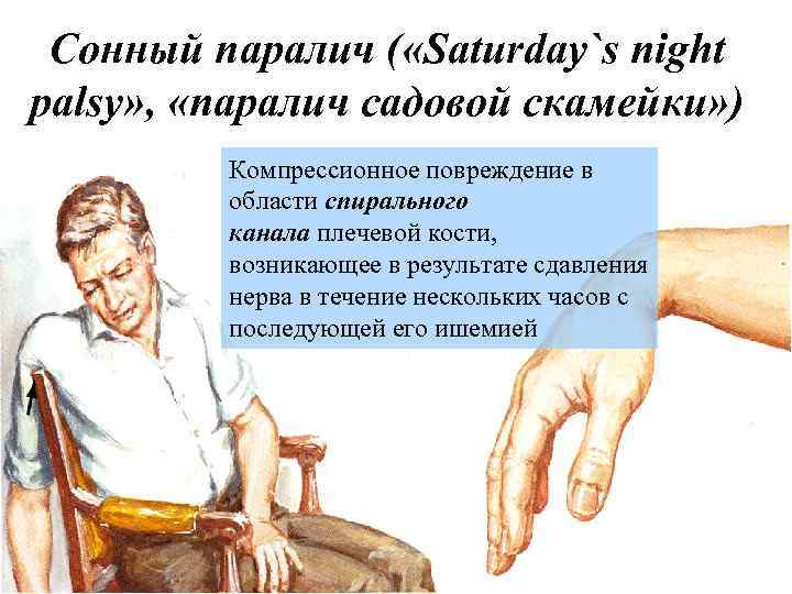 Сонный паралич ( «Saturday`s night palsy» , «паралич садовой скамейки» ) Компрессионное повреждение в