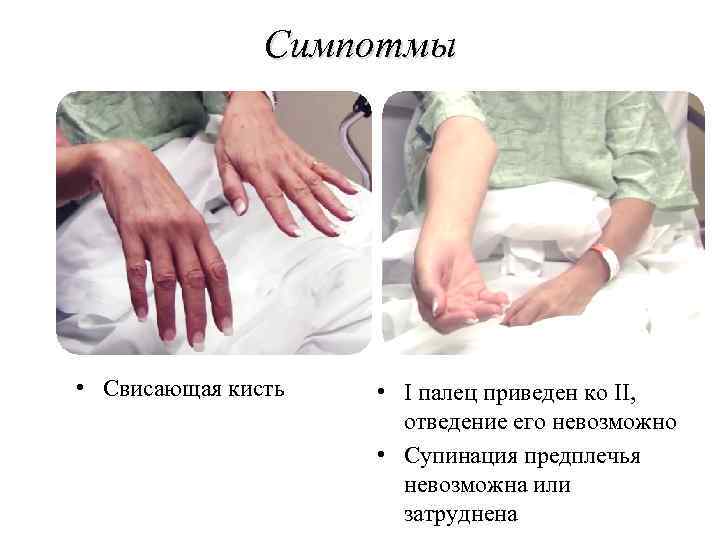 Симпотмы • Свисающая кисть • I палец приведен ко II, отведение его невозможно •