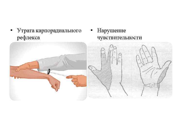  • Утрата карпорадиального рефлекса • Нарушение чувствительности 