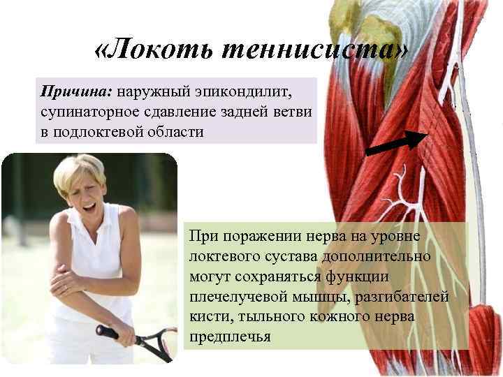  «Локоть теннисиста» Причина: наружный эпикондилит, супинаторное сдавление задней ветви в подлоктевой области При