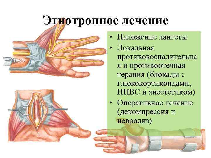 Этиотропное лечение • Наложение лангеты • Локальная противовоспалительна я и противоотечная терапия (блокады с