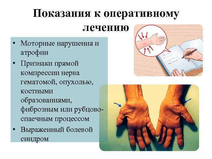Показания к оперативному лечению • Моторные нарушения и атрофии • Признаки прямой компрессии нерва
