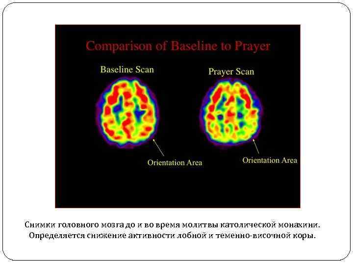 Снимки головного мозга до и во время молитвы католической монахини. Определяется снижение активности лобной