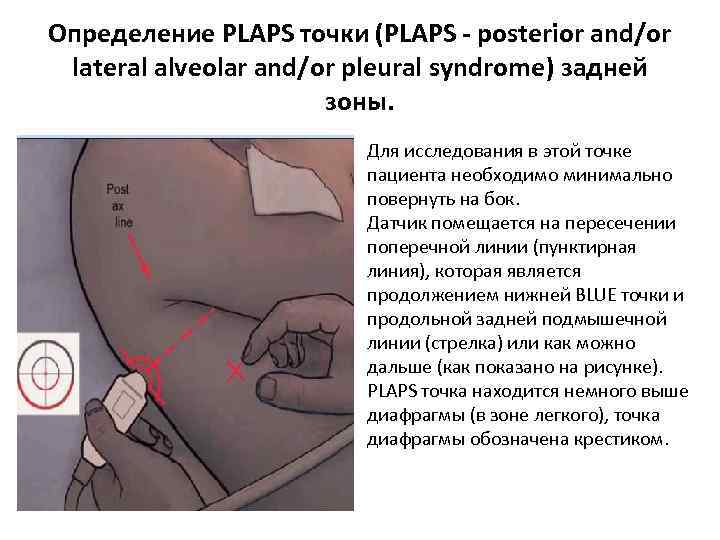 Определение PLAPS точки (PLAPS - posterior and/or lateral alveolar and/or pleural syndrome) задней зоны.