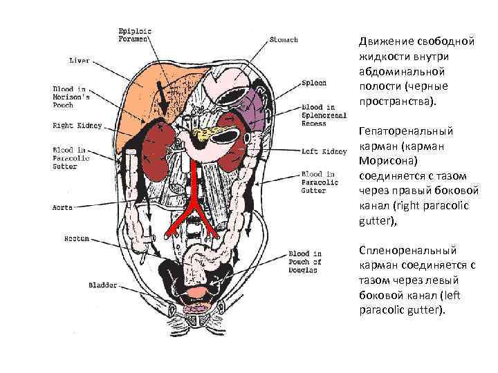 Движение свободной жидкости внутри абдоминальной полости (черные пространства). Гепаторенальный карман (карман Морисона) соединяется с