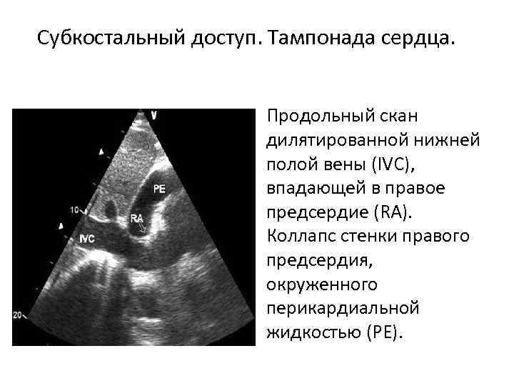 Субкостальный доступ. Тампонада сердца. Продольный скан дилятированной нижней полой вены (IVC), впадающей в правое