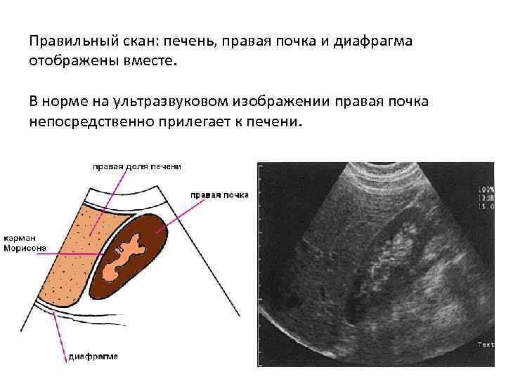 Правильный скан: печень, правая почка и диафрагма отображены вместе. В норме на ультразвуковом изображении