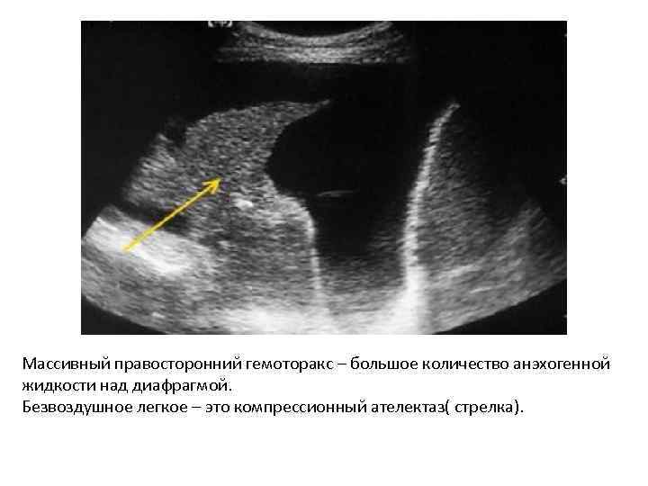 Массивный правосторонний гемоторакс – большое количество анэхогенной жидкости над диафрагмой. Безвоздушное легкое – это