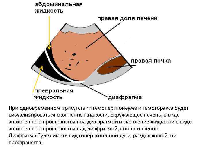 При одновременном присутствии гемоперитонеума и гемоторакса будет визуализироваться скопление жидкости, окружающее печень, в виде