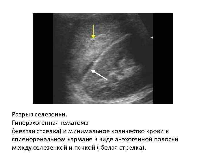 Разрыв селезенки. Подкапсульный разрыв селезенки на УЗИ. Эхограмма подкапсульный разрыв селезенки. УЗИ брюшной полости карман Моррисона.