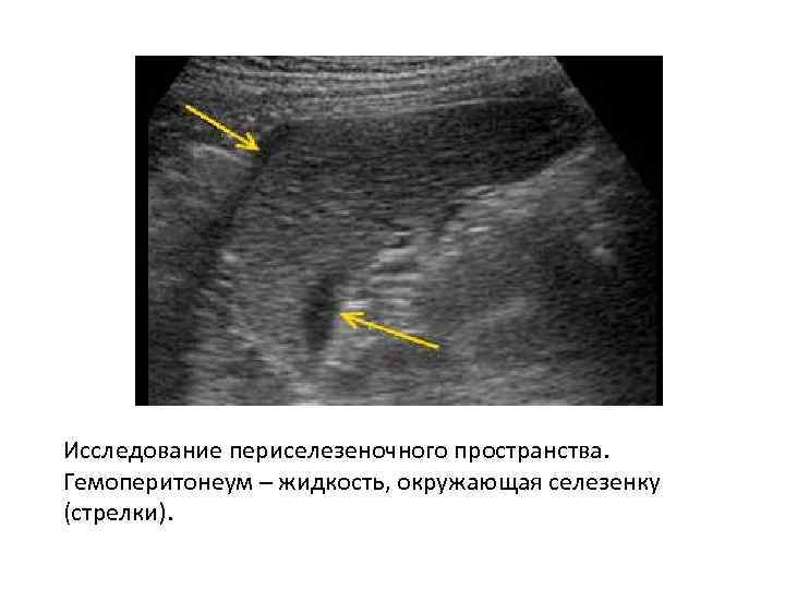 Исследование периселезеночного пространства. Гемоперитонеум – жидкость, окружающая селезенку (стрелки). 