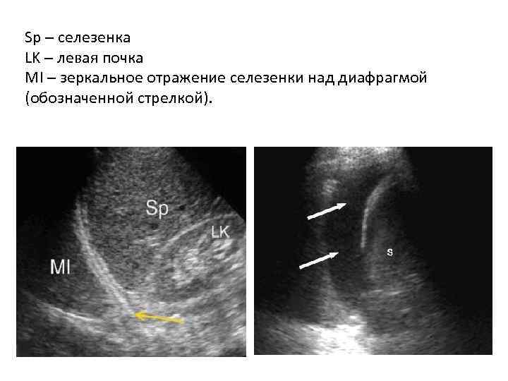 Sp – селезенка LK – левая почка MI – зеркальное отражение селезенки над диафрагмой