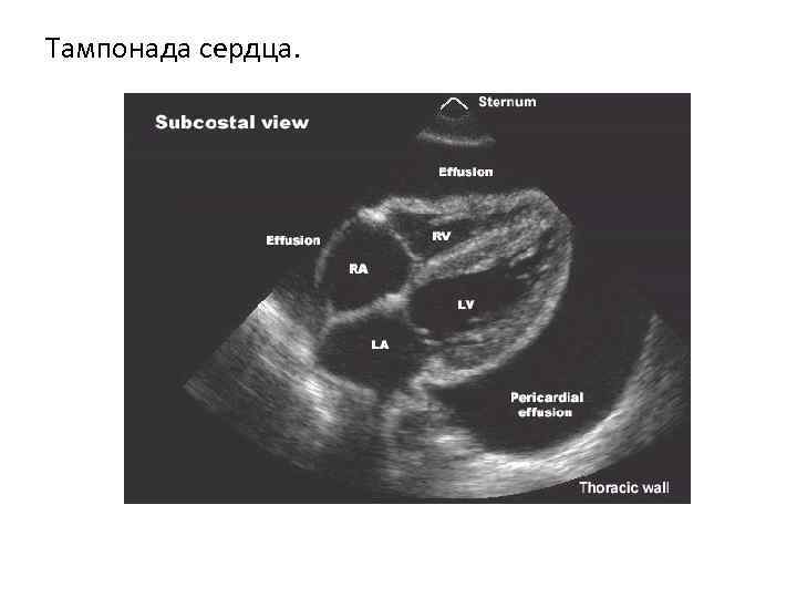 Тампонада сердца. 