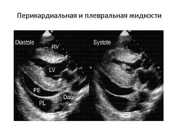 Перикардиальная и плевральная жидкости 