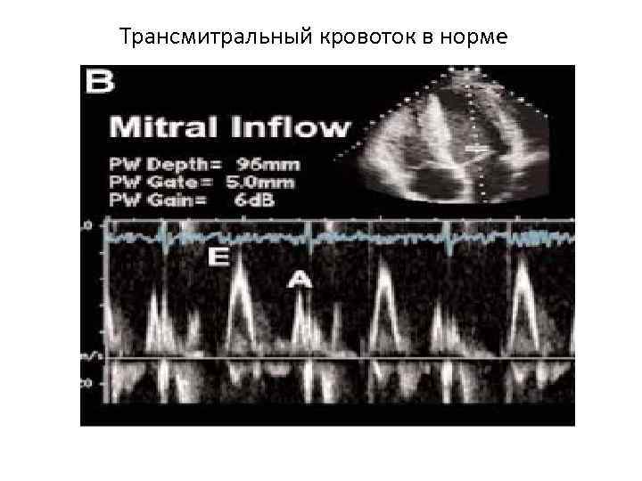 Трансмитральный кровоток в норме 