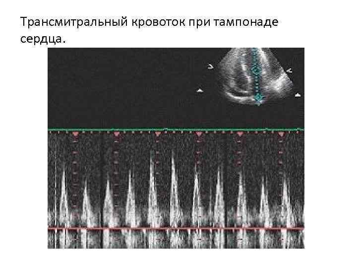 Трансмитральный кровоток при тампонаде сердца. 