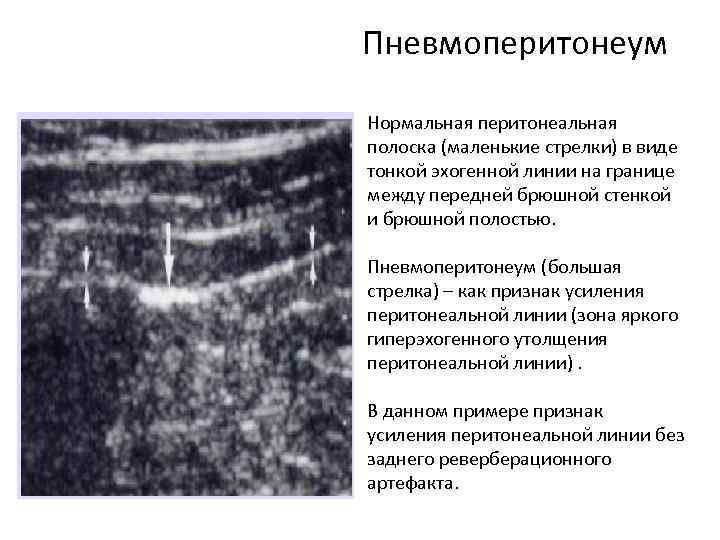 Пневмоперитонеум Нормальная перитонеальная полоска (маленькие стрелки) в виде тонкой эхогенной линии на границе между