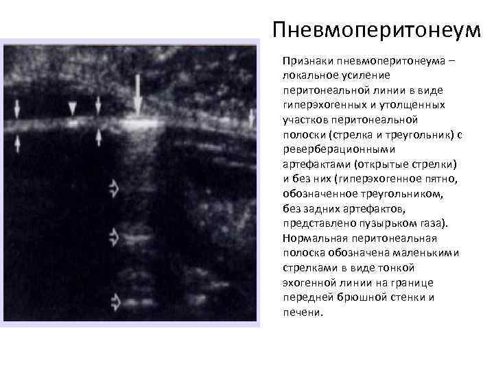 Пневмоперитонеум Признаки пневмоперитонеума – локальное усиление перитонеальной линии в виде гиперэхогенных и утолщенных участков