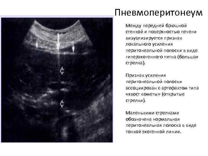 Пневмоперитонеум Между передней брюшной стенкой и поверхностью печени визуализируется признак локального усиления перитонеальной полоски