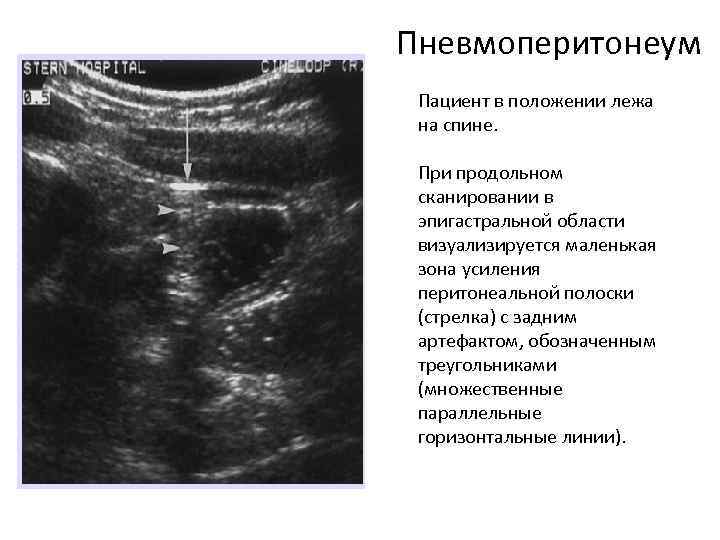 Пневмоперитонеум Пациент в положении лежа на спине. При продольном сканировании в эпигастральной области визуализируется