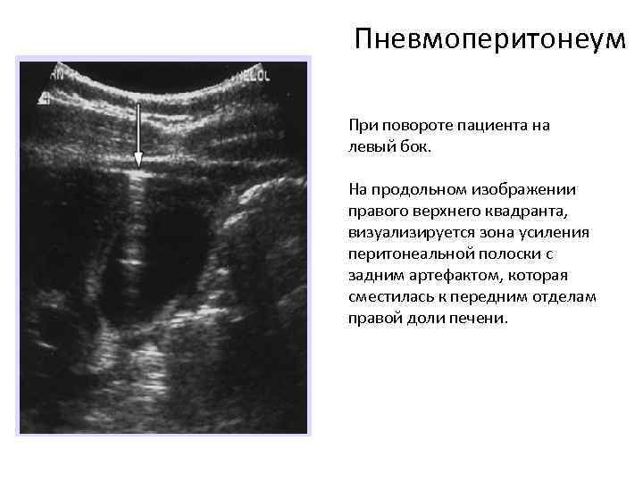 Пневмоперитонеум При повороте пациента на левый бок. На продольном изображении правого верхнего квадранта, визуализируется