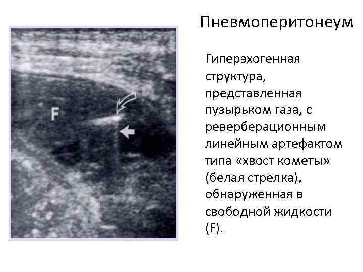Пневмоперитонеум Гиперэхогенная структура, представленная пузырьком газа, с реверберационным линейным артефактом типа «хвост кометы» (белая