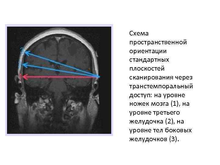 Схема пространственной ориентации стандартных плоскостей сканирования через транстемпоральный доступ: на уровне ножек мозга (1),