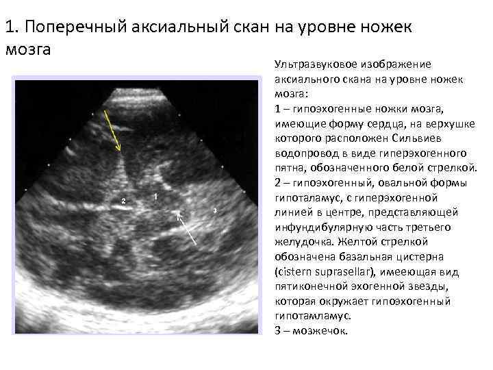 1. Поперечный аксиальный скан на уровне ножек мозга Ультразвуковое изображение аксиального скана на уровне