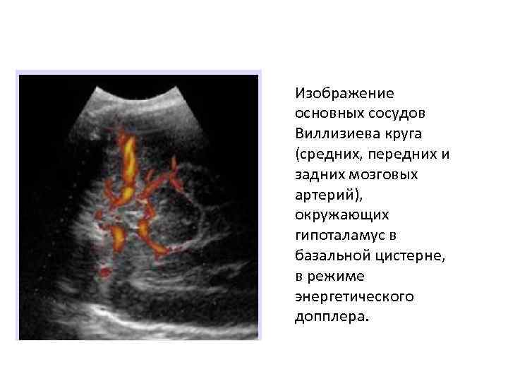 Изображение основных сосудов Виллизиева круга (средних, передних и задних мозговых артерий), окружающих гипоталамус в