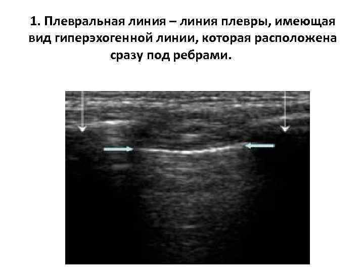 1. Плевральная линия – линия плевры, имеющая вид гиперэхогенной линии, которая расположена сразу под