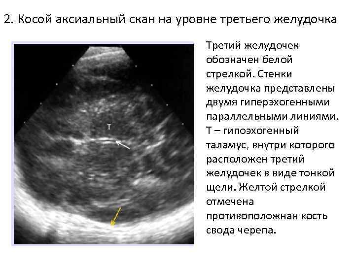 2. Косой аксиальный скан на уровне третьего желудочка Третий желудочек обозначен белой стрелкой. Стенки