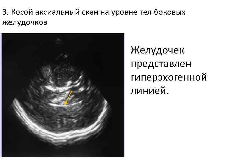 3. Косой аксиальный скан на уровне тел боковых желудочков Желудочек представлен гиперэхогенной линией. 