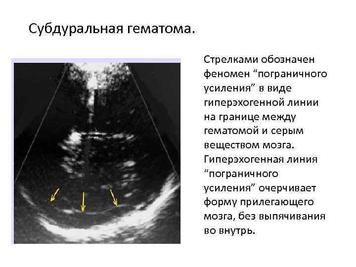 Субдуральная гематома. Стрелками обозначен феномен “пограничного усиления” в виде гиперэхогенной линии на границе между