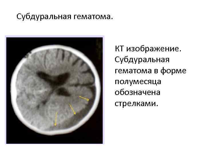 Субдуральная гематома. КТ изображение. Субдуральная гематома в форме полумесяца обозначена стрелками. 