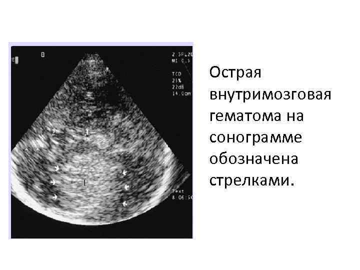 Острая внутримозговая гематома на сонограмме обозначена стрелками. 