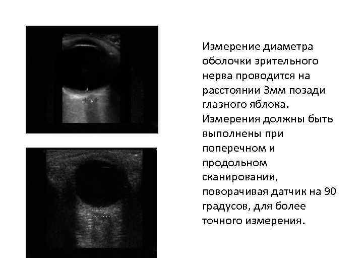 Измерение диаметра оболочки зрительного нерва проводится на расстоянии 3 мм позади глазного яблока. Измерения