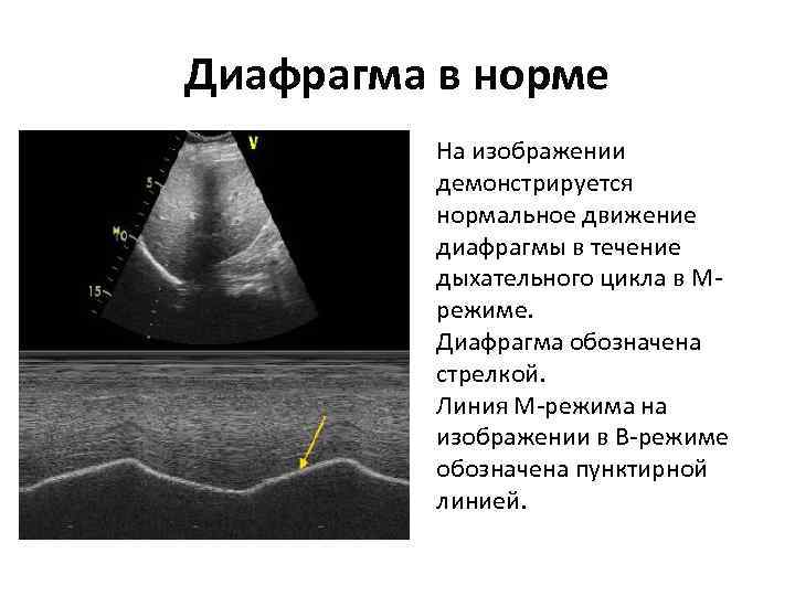 Диафрагма в норме На изображении демонстрируется нормальное движение диафрагмы в течение дыхательного цикла в