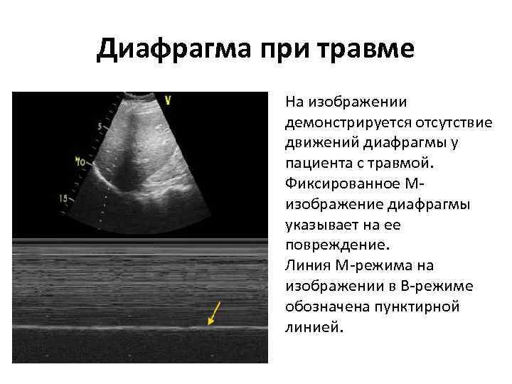 Диафрагма при травме На изображении демонстрируется отсутствие движений диафрагмы у пациента с травмой. Фиксированное