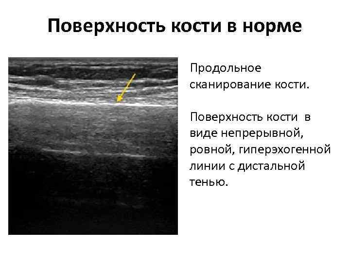 Поверхность кости в норме Продольное сканирование кости. Поверхность кости в виде непрерывной, ровной, гиперэхогенной