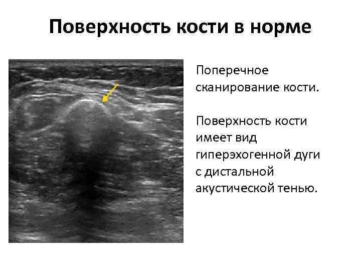 Поверхность кости в норме Поперечное сканирование кости. Поверхность кости имеет вид гиперэхогенной дуги с