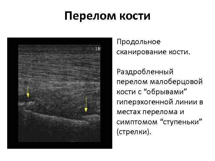 Перелом кости Продольное сканирование кости. Раздробленный перелом малоберцовой кости с “обрывами” гиперэхогенной линии в