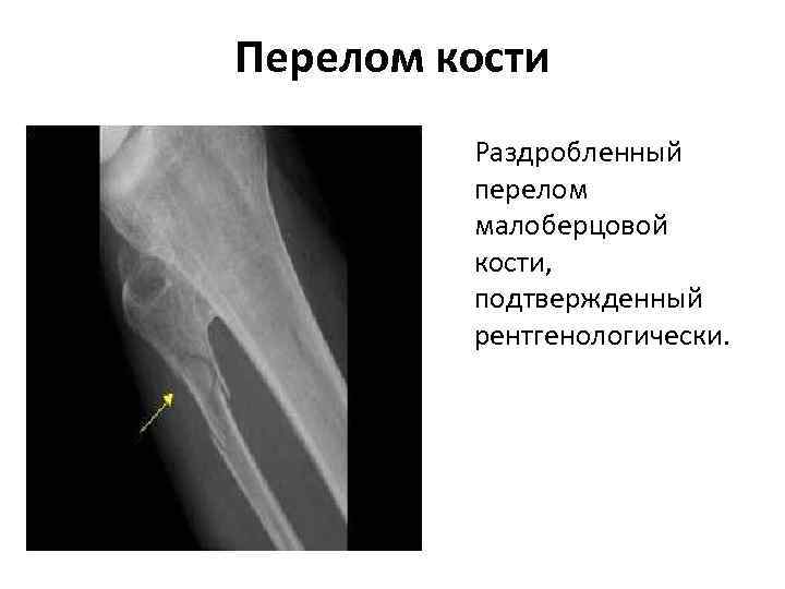 Перелом кости Раздробленный перелом малоберцовой кости, подтвержденный рентгенологически. 