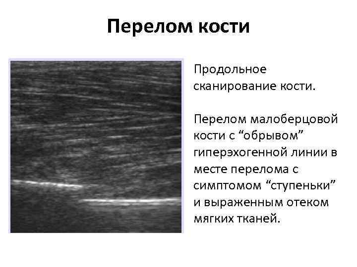 Перелом кости Продольное сканирование кости. Перелом малоберцовой кости с “обрывом” гиперэхогенной линии в месте