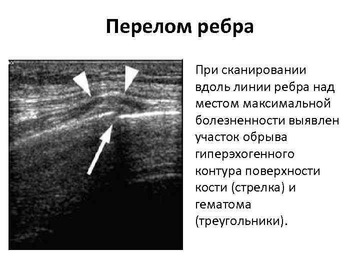 Перелом ребра При сканировании вдоль линии ребра над местом максимальной болезненности выявлен участок обрыва