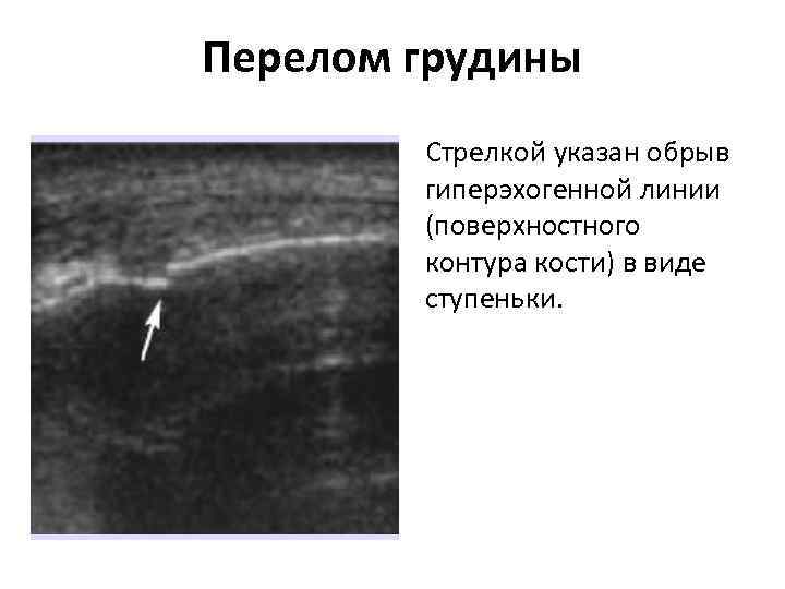 Перелом грудины Стрелкой указан обрыв гиперэхогенной линии (поверхностного контура кости) в виде ступеньки. 